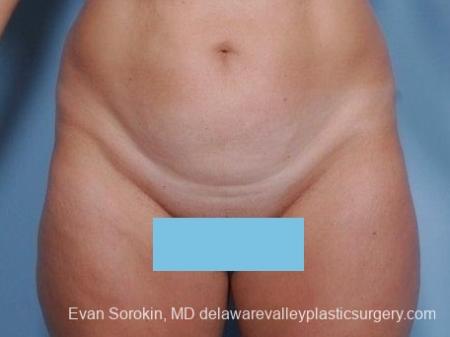 Philadelphia Abdominoplasty 8682 - Before Image 1