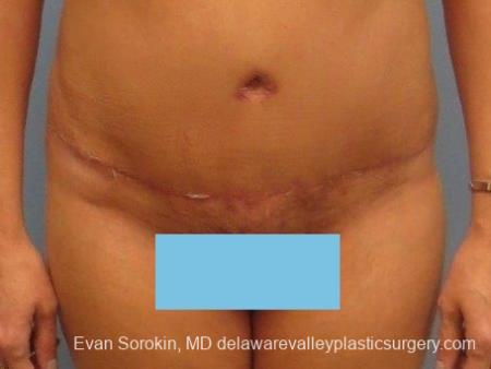 Philadelphia Abdominoplasty 8672 - After Image 1