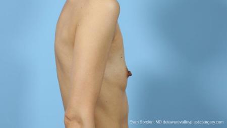 Philadelphia Breast Augmentation 9291 - Before Image 3