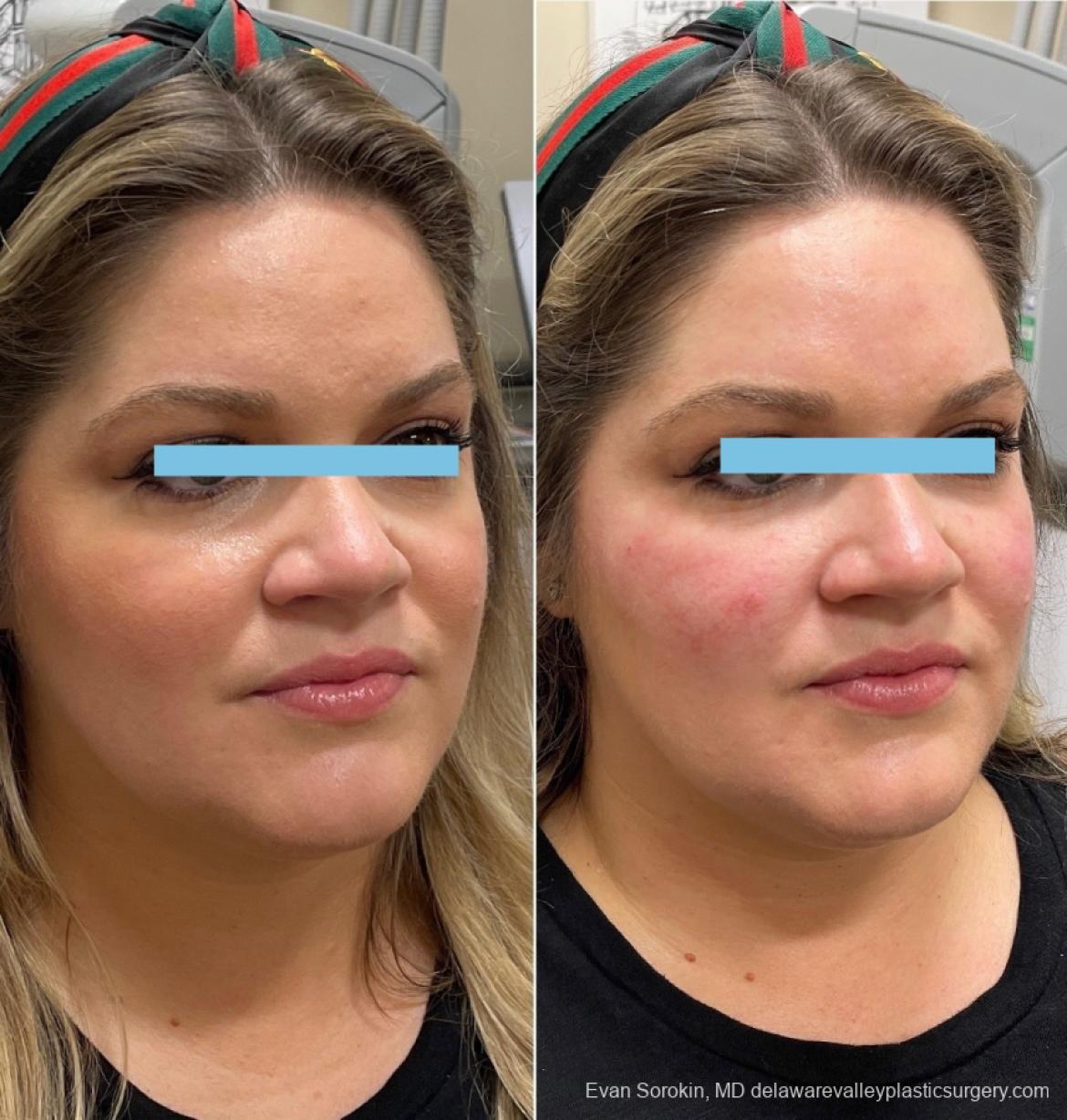 Fillers: Patient 20 - Before and After 2