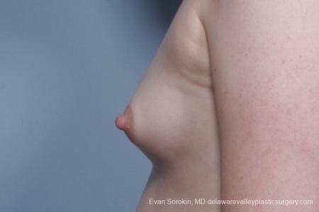 Philadelphia Top Surgery Male to Female 8642 - Before and After Image 5