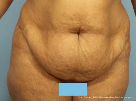 Philadelphia Abdominoplasty 9462 - Before Image 1