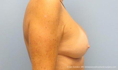 Philadelphia Breast Augmentation 9600 - After Image 3