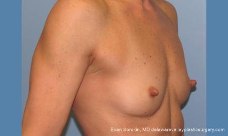 Philadelphia Breast Augmentation 9744 - Before Image 2