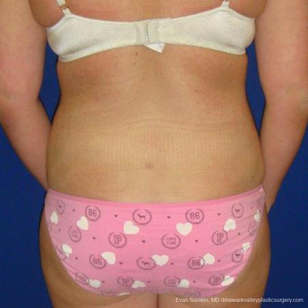 Philadelphia Liposuction 9484 - After Image 5