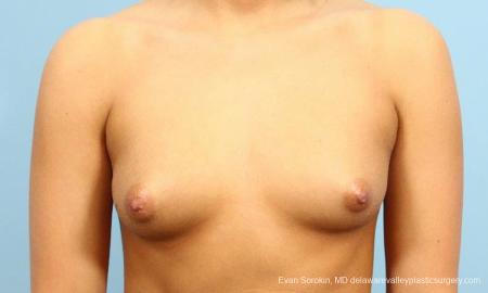 Philadelphia Breast Augmentation 9393 - Before Image 1