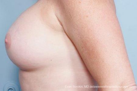 Philadelphia Breast Augmentation 9316 - After Image 5