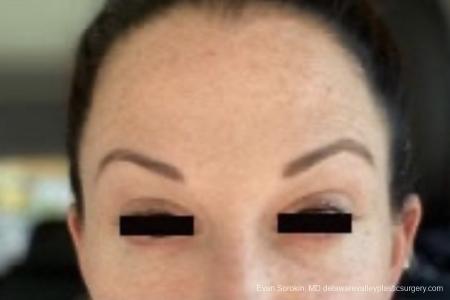 BOTOX® Cosmetic: Patient 3 - After Image 1