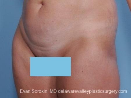 Philadelphia Abdominoplasty 8682 - Before Image 3