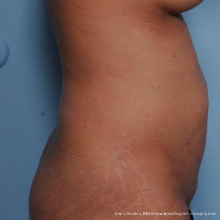Philadelphia Abdominoplasty 9479 - Before Image 3