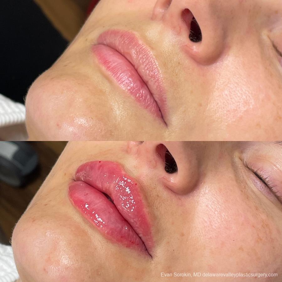 Lip Filler: Patient 36 - Before and After 3