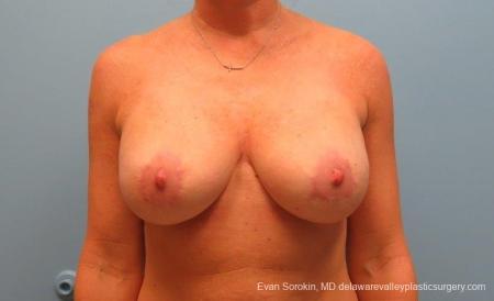 Philadelphia Breast Lift and Augmentation 8690 - After Image 1