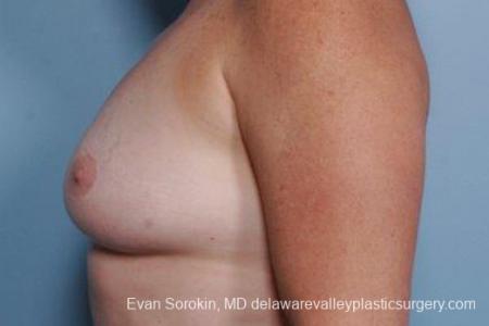 Philadelphia Breast Augmentation 9316 - Before and After Image 5