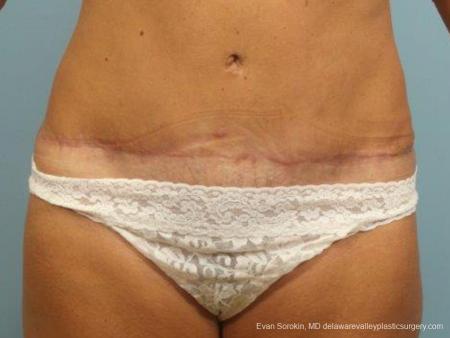 Philadelphia Abdominoplasty 9464 - After Image 1