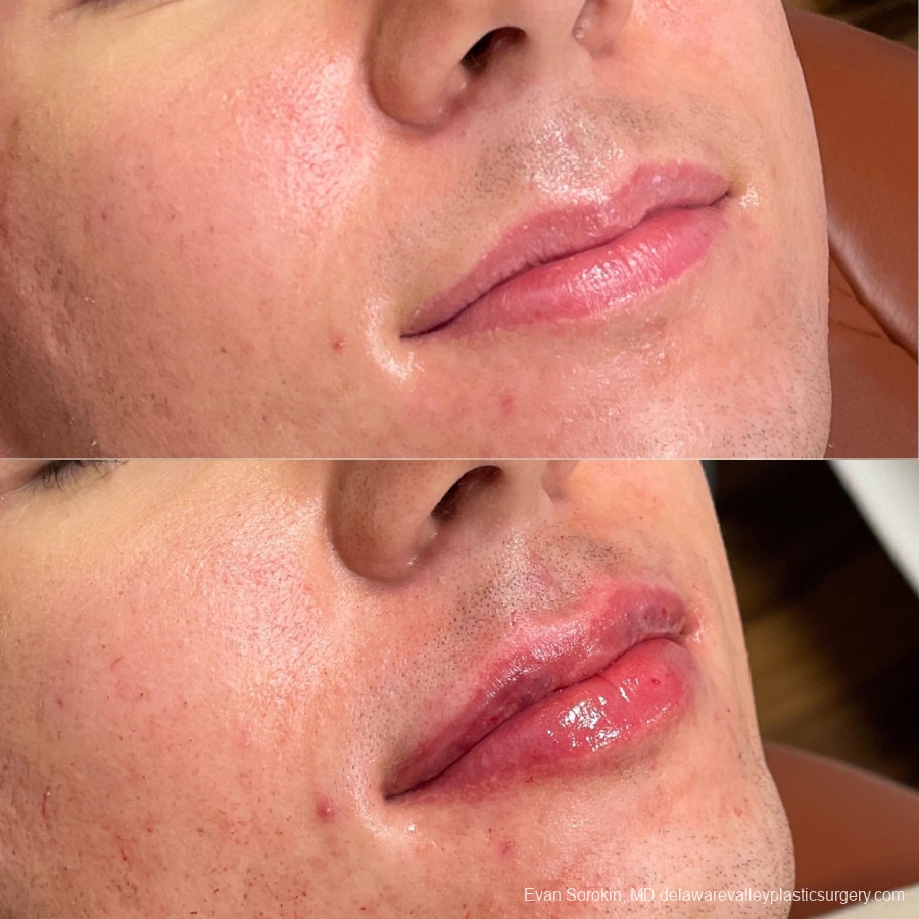 Lip Augmentation: Patient 51 - Before and After 2