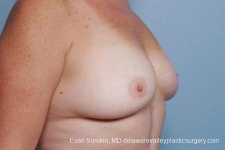 Philadelphia Breast Augmentation 9316 - Before Image 2
