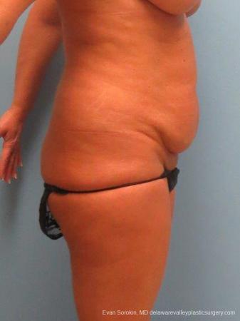 Philadelphia Abdominoplasty 9463 - Before Image 3