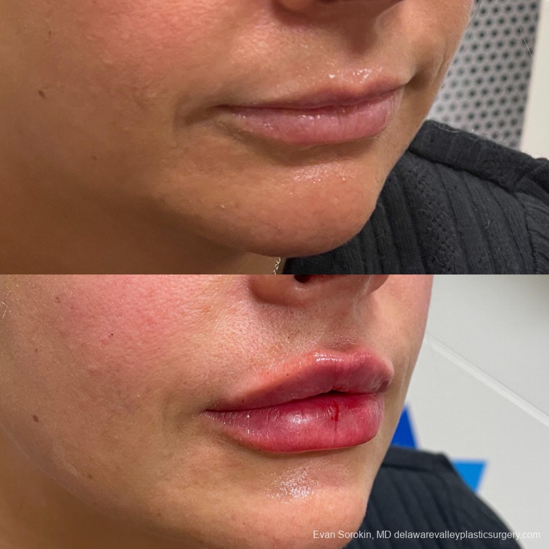 Fillers: Patient 23 - Before and After 2