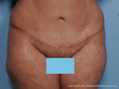 Philadelphia Abdominoplasty 9462 - After Image 1