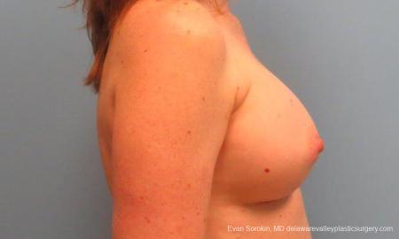 Philadelphia Breast Augmentation 9180 - After Image 3