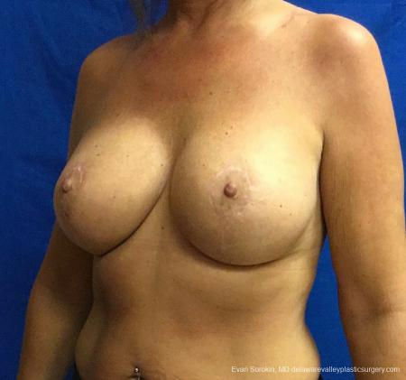 Philadelphia Breast Lift and Augmentation 13068 - After 4