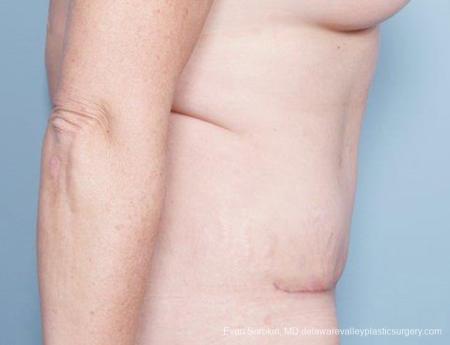 Philadelphia Abdominoplasty 9315 - After Image 5
