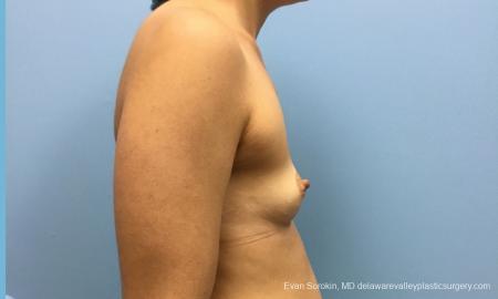 Philadelphia Breast Augmentation 12519 - Before Image 4