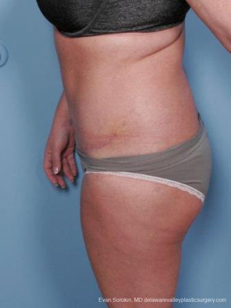 Philadelphia Abdominoplasty 9463 - After Image 5