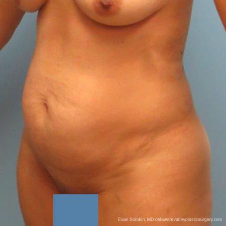 Philadelphia Abdominoplasty 9478 - Before Image 2