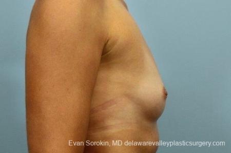 Philadelphia Breast Augmentation 8764 - Before Image 4