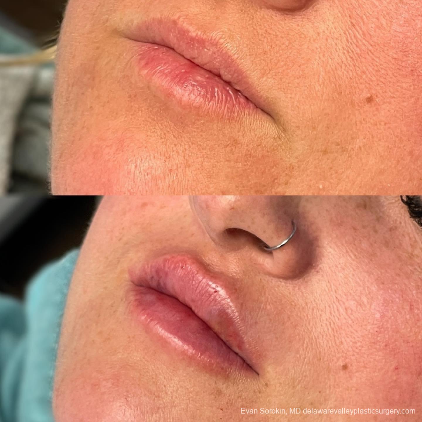 Lip Augmentation: Patient 59 - Before and After 3