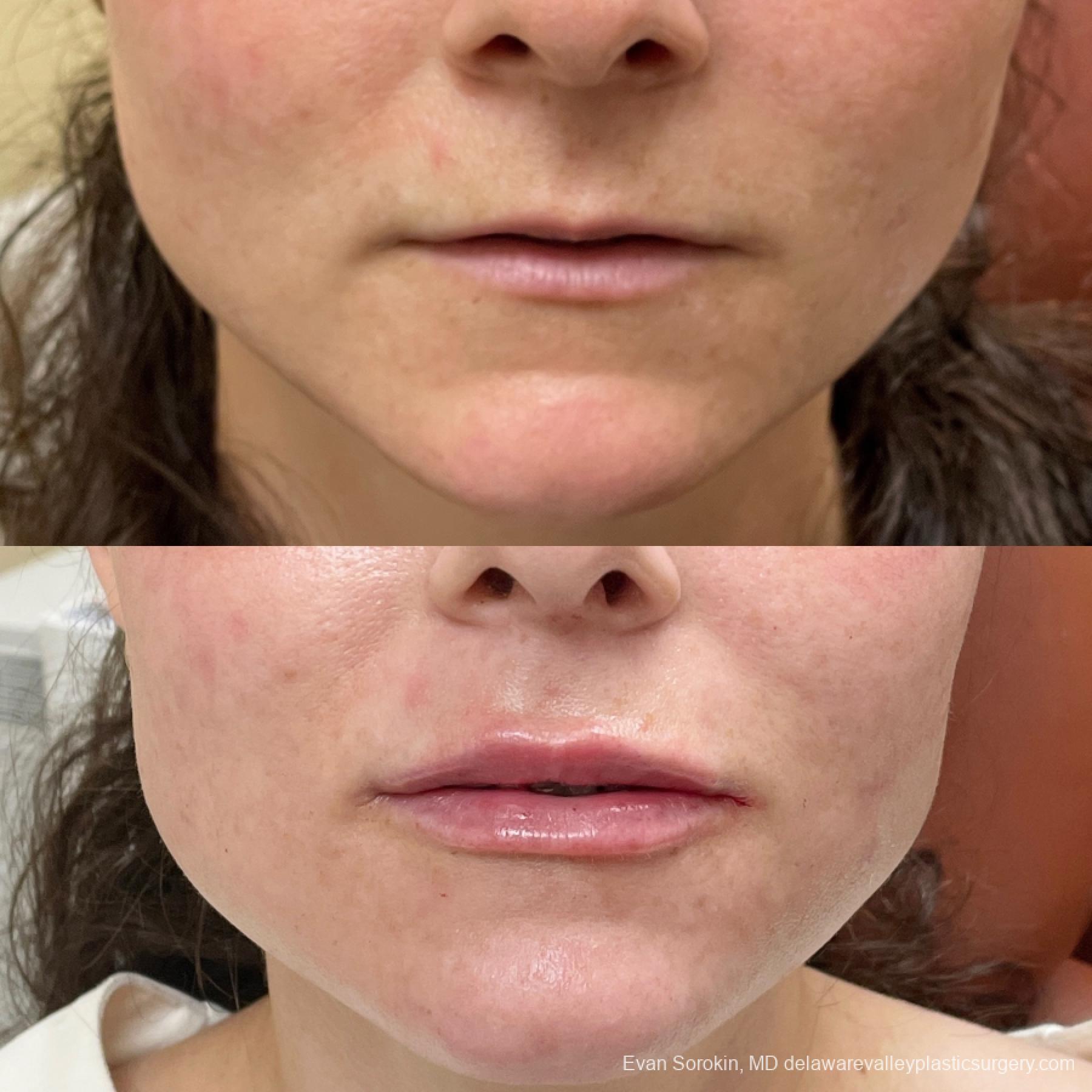 Lip Augmentation: Patient 20 - Before and After 