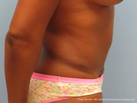 Philadelphia Abdominoplasty 9339 - After Image 3