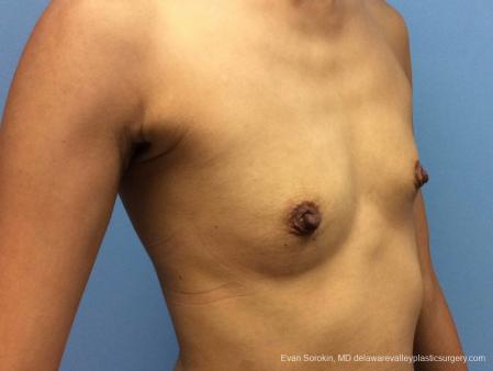 Philadelphia Breast Augmentation 13071 - Before Image 2