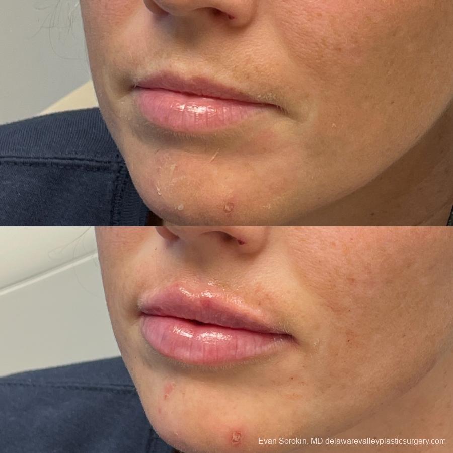 Lip Augmentation: Patient 18 - Before and After 3
