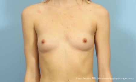 Philadelphia Breast Augmentation 8660 - Before Image 1
