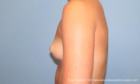 Philadelphia Breast Augmentation 9621 - Before and After Image 5