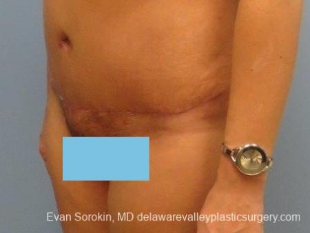 Philadelphia Abdominoplasty 8672 - After Image 3