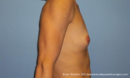 Philadelphia Breast Augmentation 10248 - Before Image 3