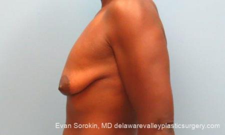 Philadelphia Breast Lift and Augmentation 10120 - Before and After Image 4