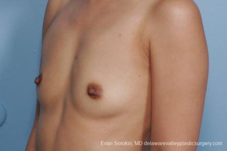 Philadelphia Breast Augmentation 8661 - Before Image 3