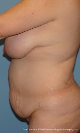 Philadelphia Mommy Makeover 9429 - Before and After Image 5