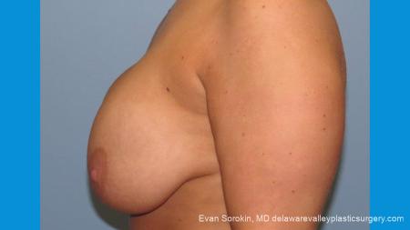 Philadelphia Breast Augmentation 10089 - Before and After Image 5