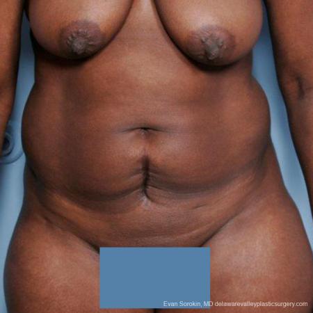 Philadelphia Abdominoplasty 9477 - Before Image 1