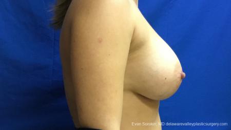 Philadelphia Breast Augmentation 13173 - After Image 3