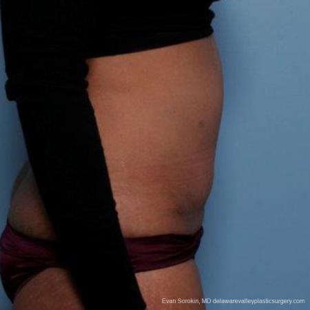 Philadelphia Abdominoplasty 9479 - After Image 3