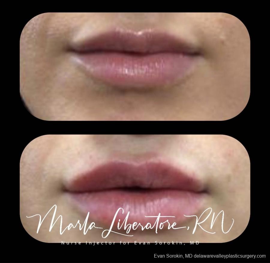 Lip Filler: Patient 1 - Before and After Image 1
