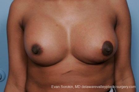 Philadelphia Breast Lift and Augmentation 8689 - After Image 1