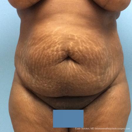 Philadelphia Abdominoplasty 10817 - Before Image 1