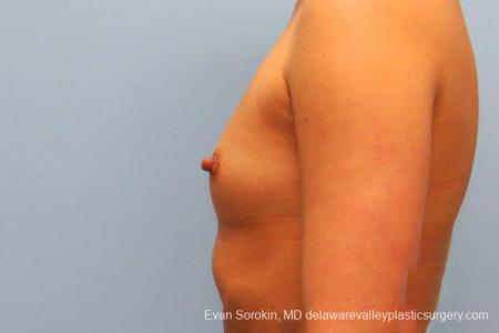 Philadelphia Breast Augmentation 9410 - Before and After Image 5